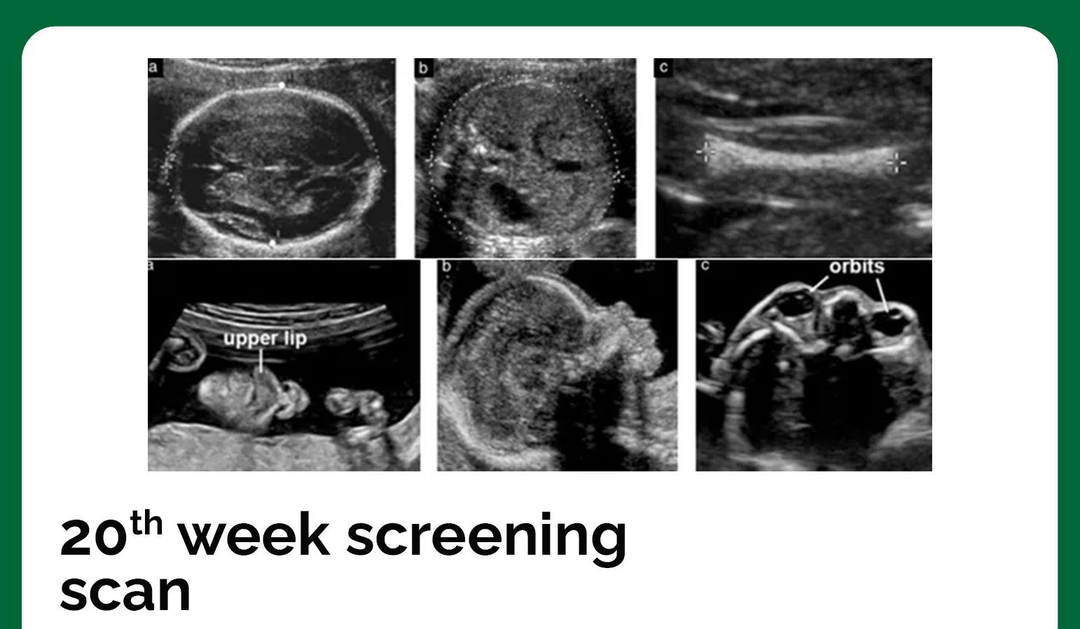 20th week screening scan