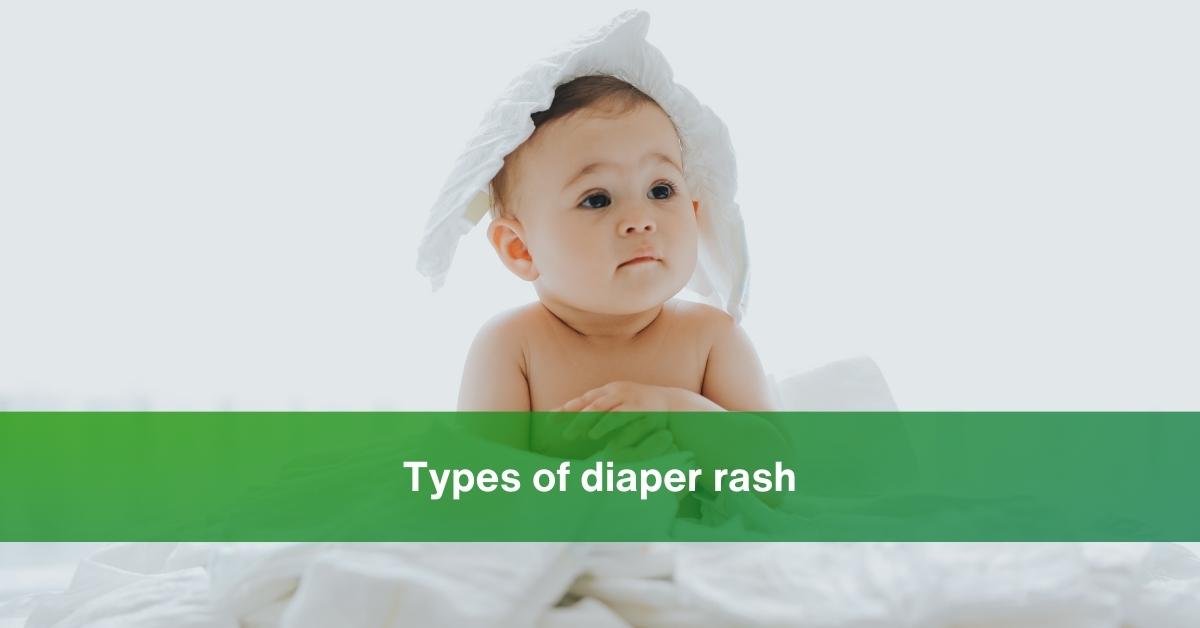 How Can You Prevent Diaper Rash In Babies? Expert Valuable Tips 