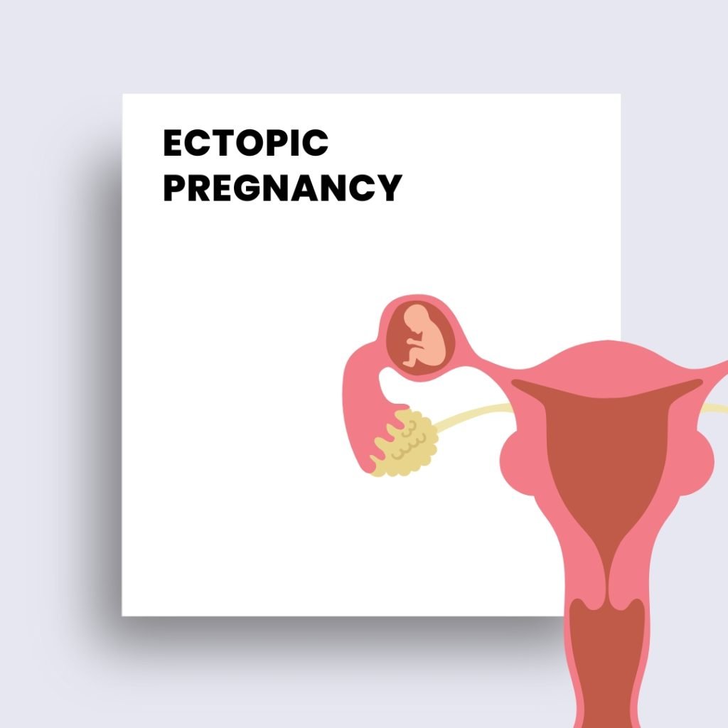 ectopic pregnancy