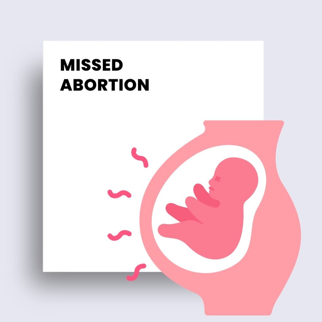 missed abortion