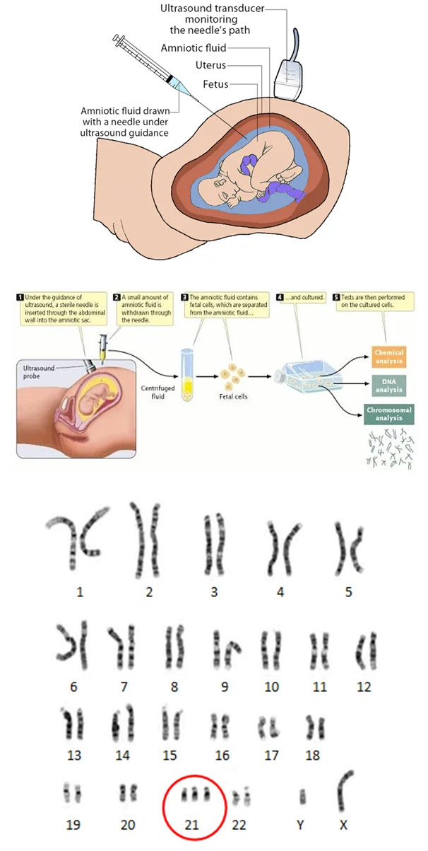 Amniocentesis-Procedure