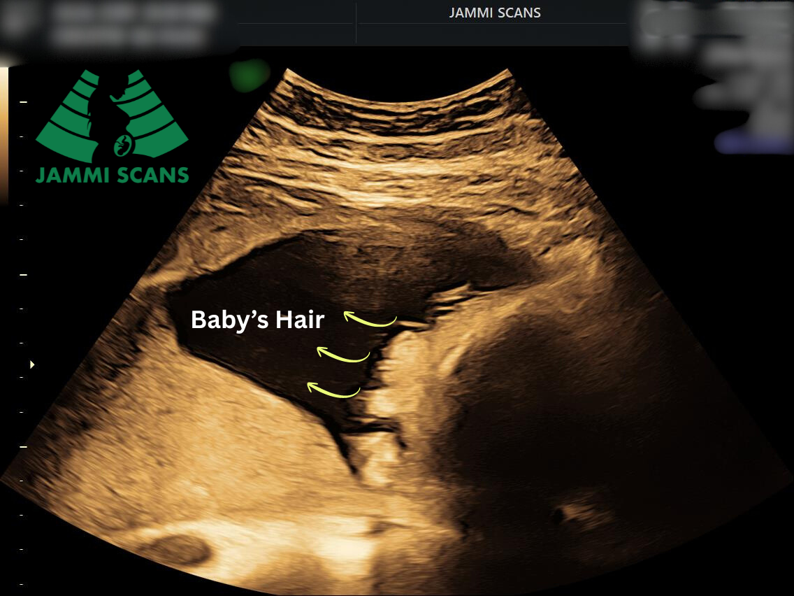 Baby’s Hair on a pregnancy scan Baby’s Hair on a pregnancy scan